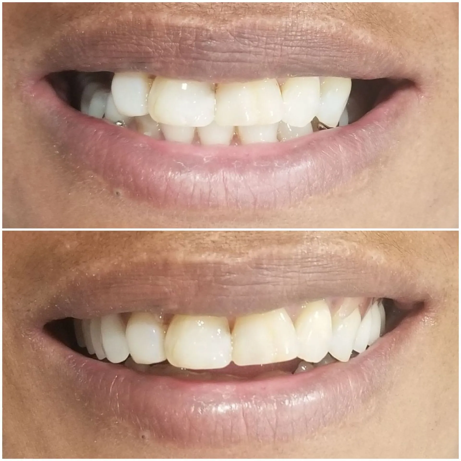 WOW Dental before and after result