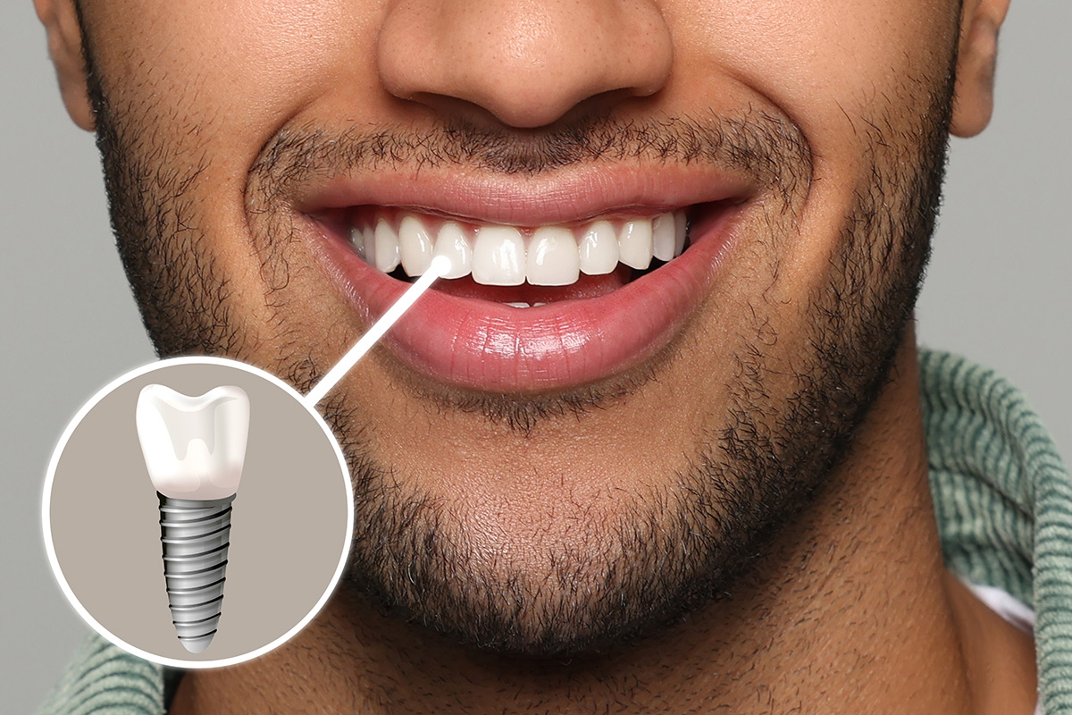 Wow Dental|Implants