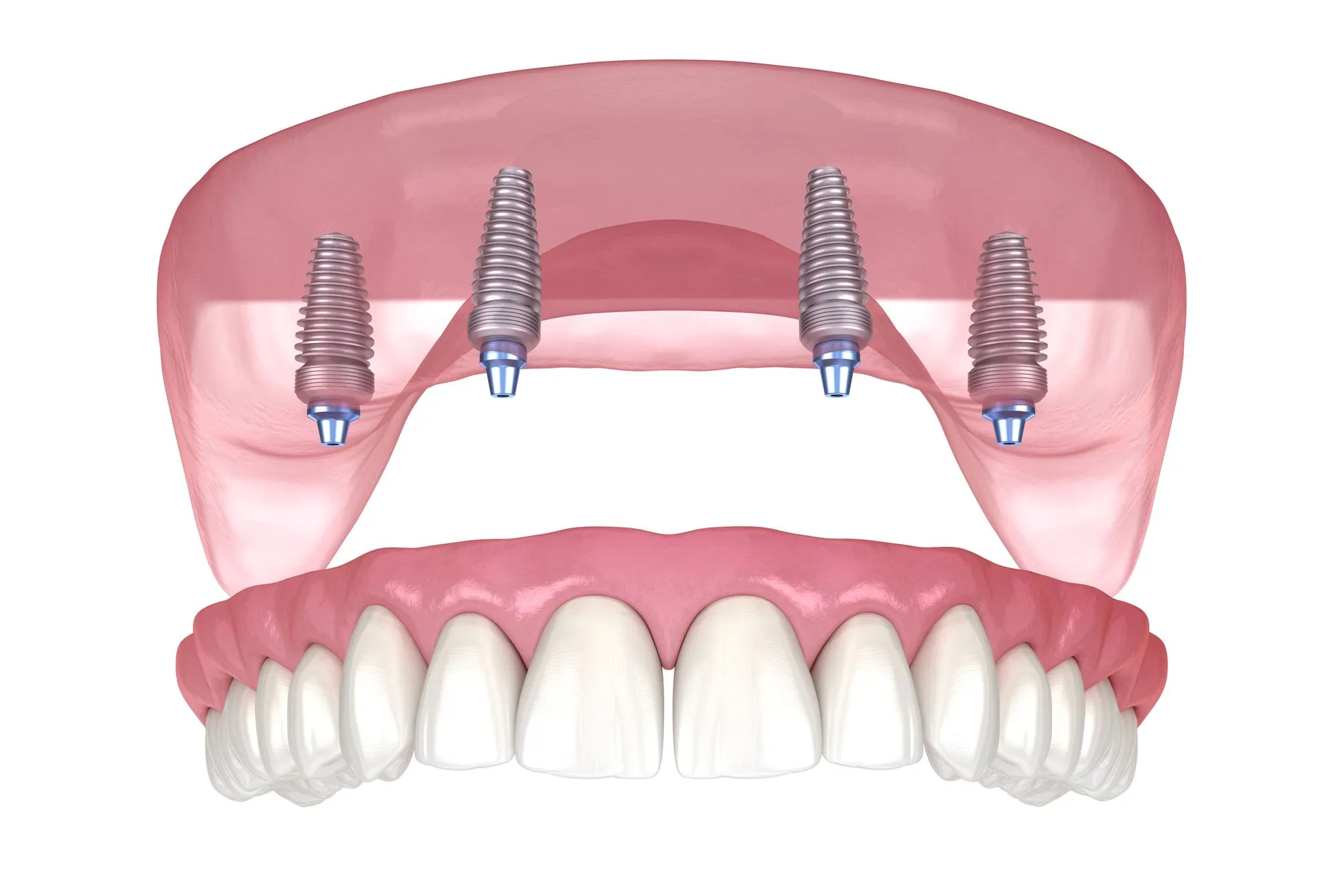 Wow Dental|Implants