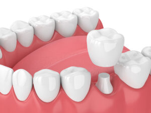 Wow Dental | Dental Crowns in Detroit: Strong, Natural Repair for Damaged Teeth
