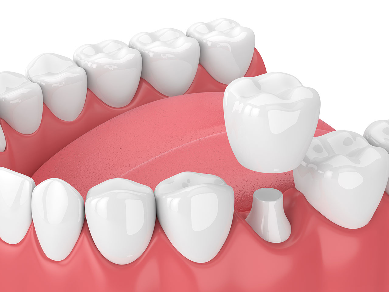 Dental Crowns in Detroit: Strong, Natural Repair for Damaged Teeth